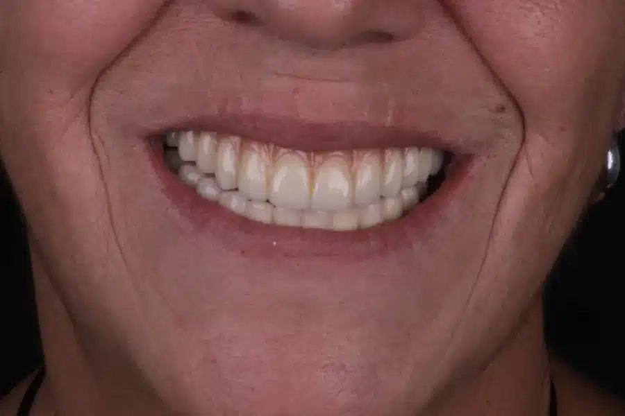 Sonrisa de una paciente tras su rehabilitación dental en Bucodontos