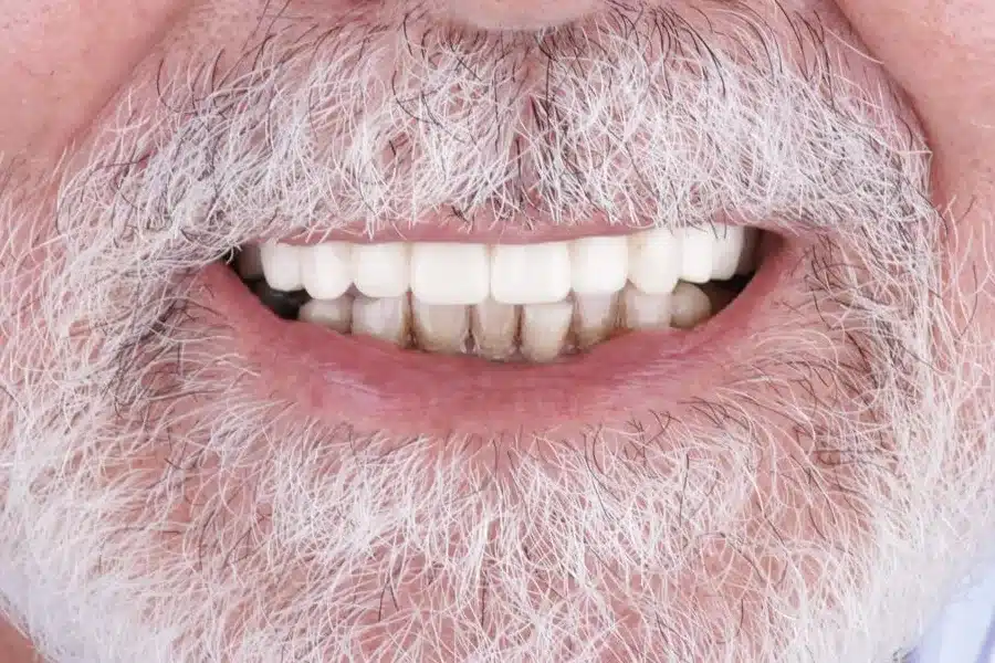 Sonrisa de un paciente tras su rehabilitación dental en Bucodontos